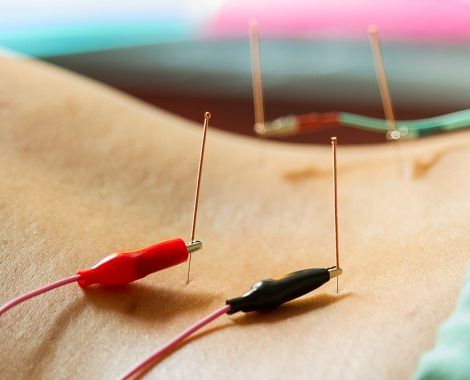 ElectroAcupuncture.jpg